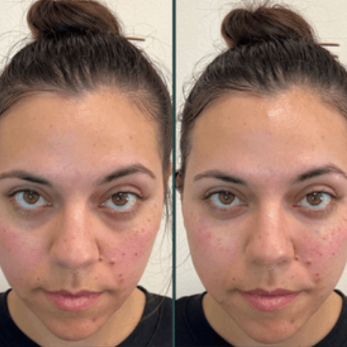 Elyskin - Soin contour des yeux 3 en 1 avec embout massant lumière rouge