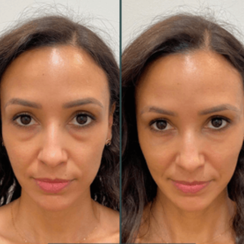 Elyskin - Soin contour des yeux 3 en 1 avec embout massant lumière rouge
