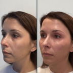 Elyskin - Soin contour des yeux 3 en 1 avec embout massant lumière rouge